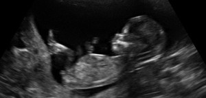 11-week-old-fetus-e1403847026583
